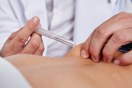 Implant Syringe- doctor performing a subcontaneous injection doctor performs a subcontaneous injection